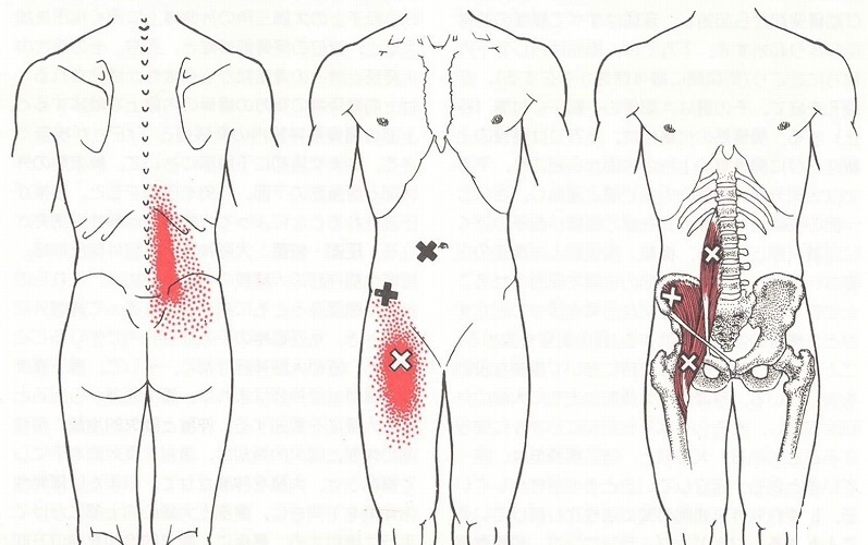 ぎっくり腰のトリガーポイント疼痛パターン