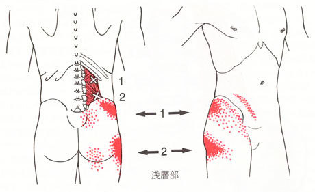 股関節症に関わる腰のトリガーポイント