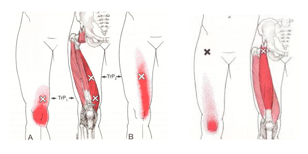 膝痛のトリガーポイント