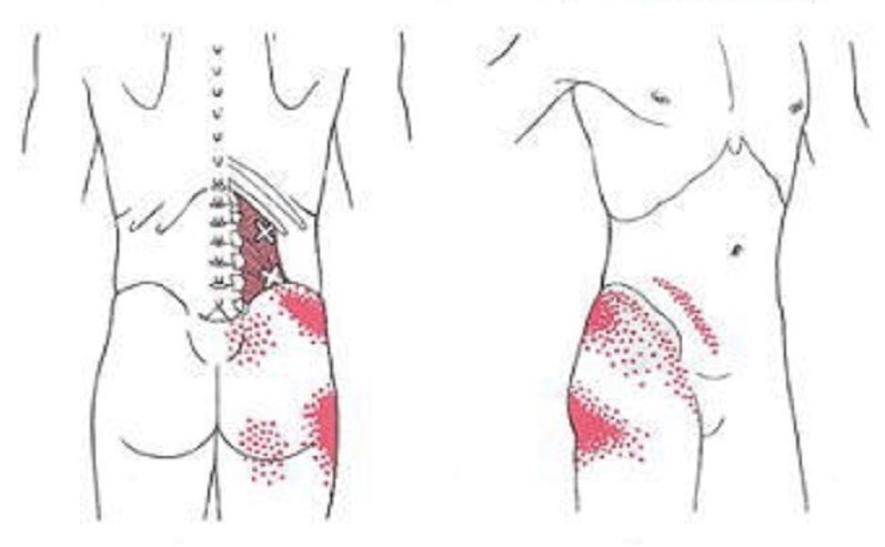 腰痛のトリガーポイント疼痛パターン