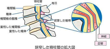 脊柱管狭窄症の拡大図