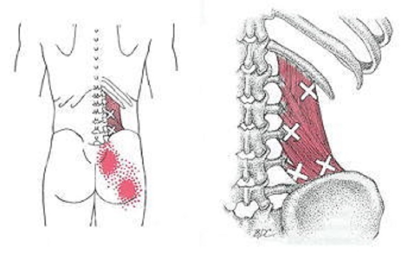 腰方形筋のトリガーポイント疼痛パターン