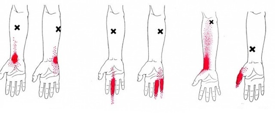 側頭筋のトリガーポイント