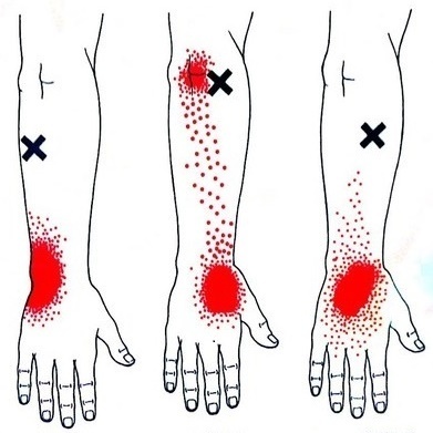 胸鎖乳突筋のトリガーポイント