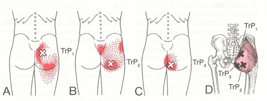 大殿筋のトリガーポイント
