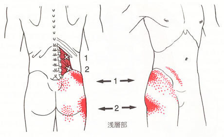 股関節症に関わる腰のトリガーポイント