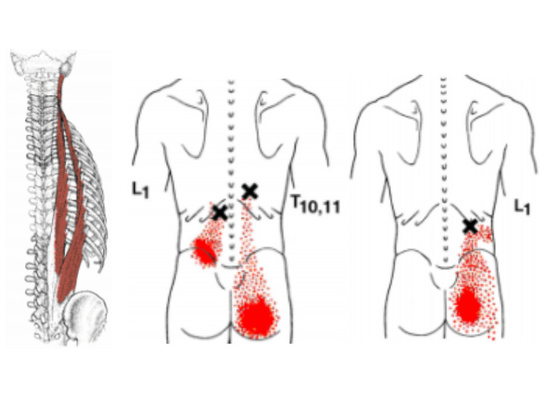 起立筋のトリガーポイント
