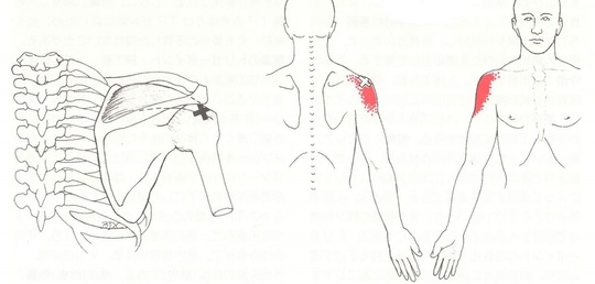 四十肩、五十肩のトリガーポイント