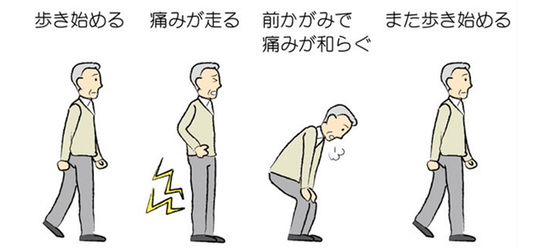間欠跛行の説明