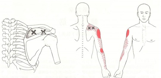 四十肩、五十肩のトリガーポイント