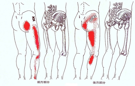小殿筋のトリガーポイント
