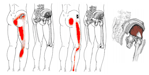 中殿筋のトリガーポイント