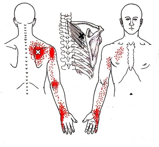 頭痛のトリガーポイント