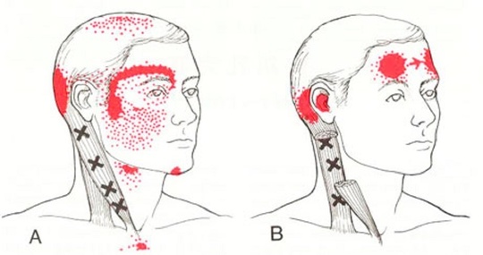 胸鎖乳突筋のトリガーポイント
