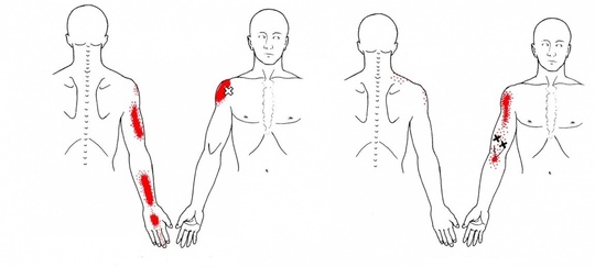 四十肩、五十肩のトリガーポイント