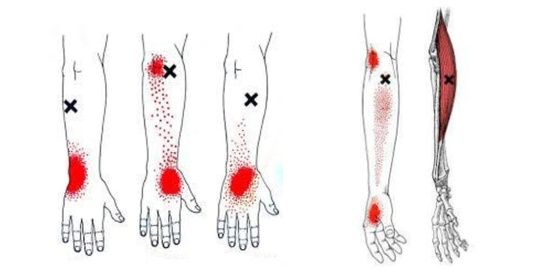 腕の痛みのトリガーポイント