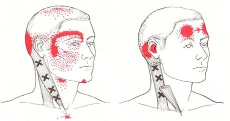 頭痛のトリガーポイント