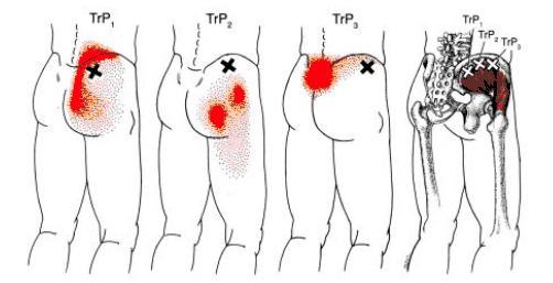 中殿筋のトリガーポイント疼痛パターン