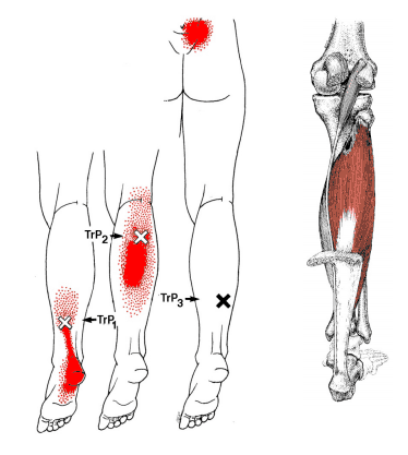 ヒラメ筋のトリガーポイント疼痛パターン