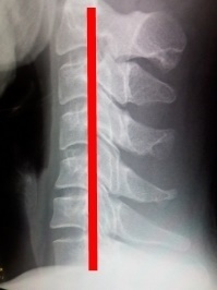 ストレートネックの角度