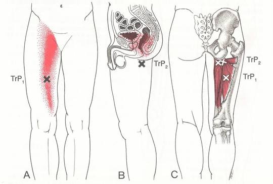 大内転筋のトリガーポイント