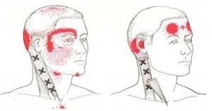 トリガーポイント