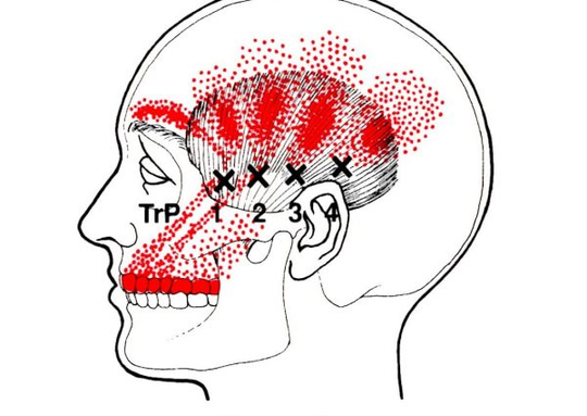 側頭筋のトリガーポイント