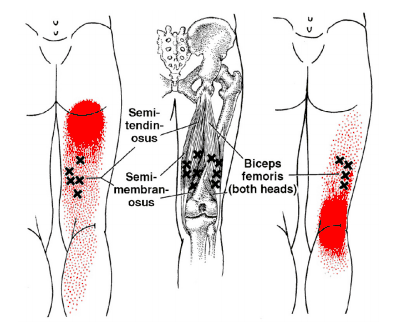 ハムストリングスのトリガーポイント疼痛パターン